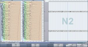 Compressed Spectral Arrays, CSA, EEG
